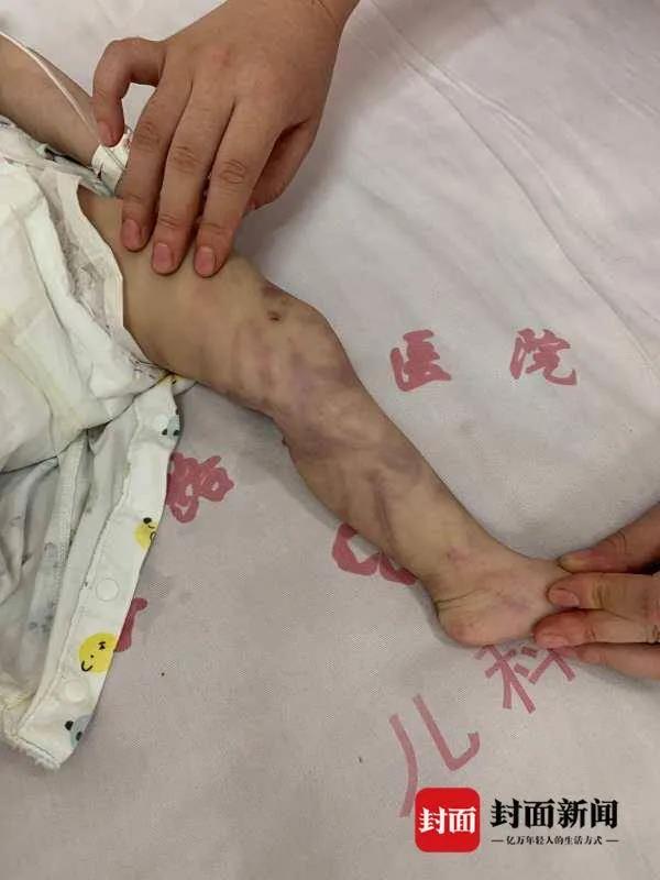 成都1岁男童被生母打伤：入院时面色青灰色 仅有6.5公斤
