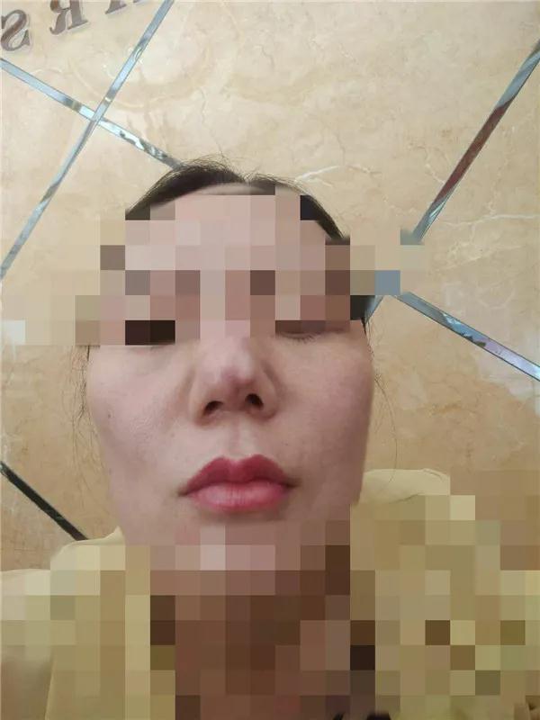 郑州爱美丽整形美容医院：女子隆鼻整容变毁容，称“副院长”在小区做的手术
