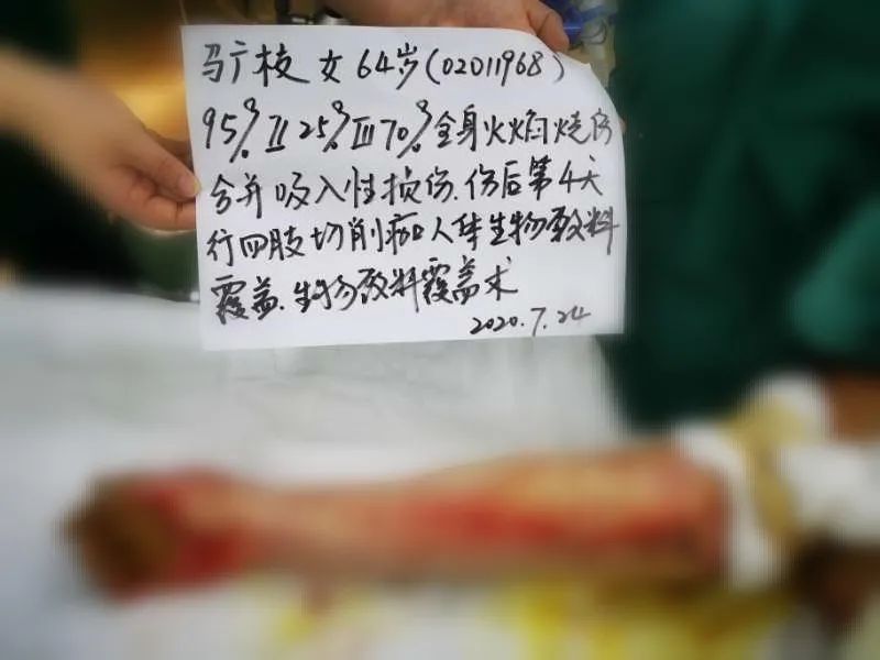 我身上任何部位都可以给她!煤气爆炸95%重度烧伤 新乡男子割皮救母