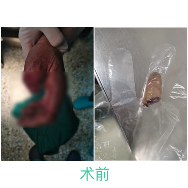 宝丰县医疗健康集团人民医院院区成功为患者实施断指再植手术