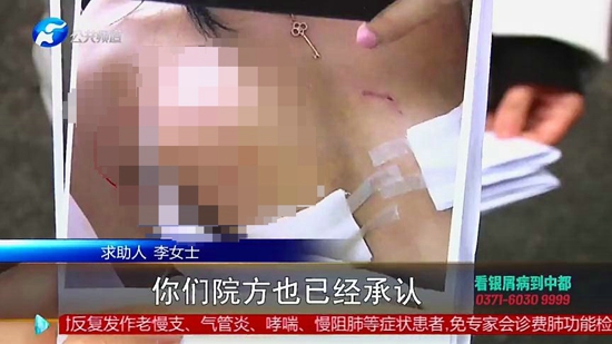 女子在郑州集美整形医院隆胸后假体移位、无知觉，面临切除风险医院：跟个人体质有关