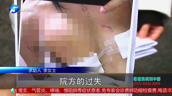 女子在郑州集美整形医院隆胸后假体移位、无知觉，面临切除风险医院：跟个人体质有关