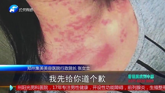 女子在郑州集美整形医院隆胸后假体移位、无知觉，面临切除风险医院：跟个人体质有关