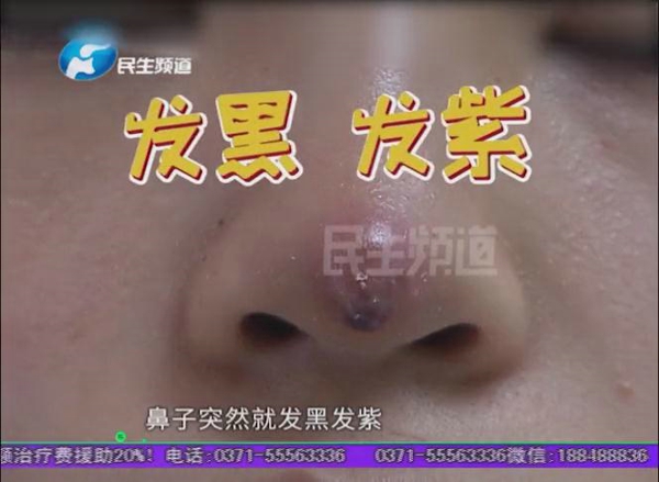 “朋友说我是一只米老鼠”郑州一女子在幻颜整形医院整鼻后鼻头发黑发紫