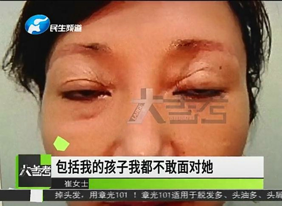 河南郑州：女子爱美做双眼皮，割完之后惊呆了，变成凶神恶煞？