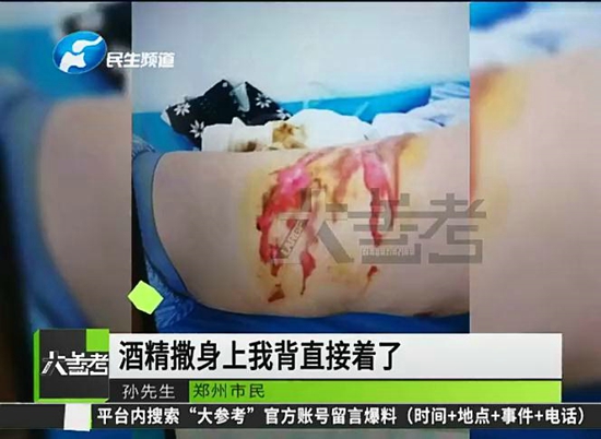 河南郑州：凌晨足疗店拔火罐，女技师操作不当背部被烧伤，小伙儿直呼没想到