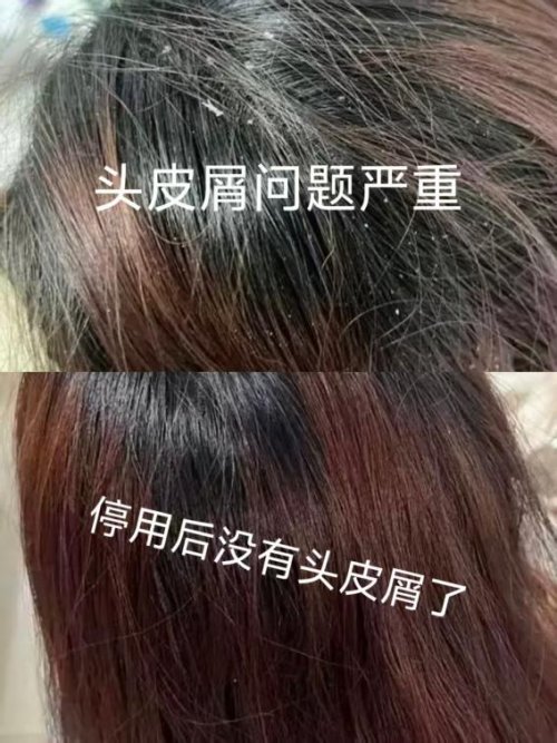 头屑反复的人，为什么头皮越来越敏感？2026 年uuba头部护理膏深度解析真实机制