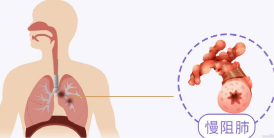 中老年慢阻肺调理避坑!养无极补肺丸,品牌强国认证,家庭常备更省心