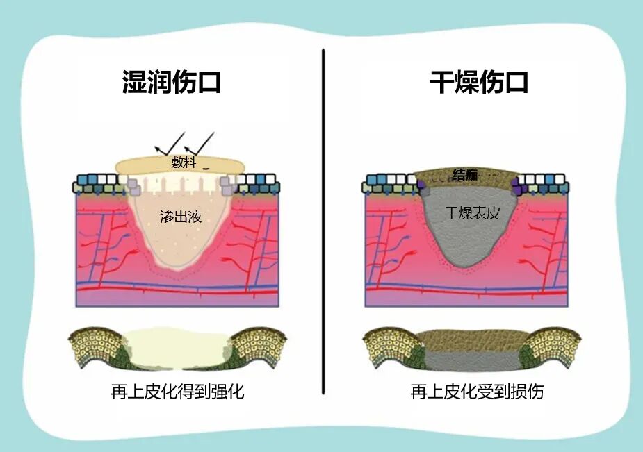 伤口晾干好，还是保湿好？很多人第一步就错了