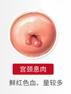 宫颈息肉“卷土重来”？长沙南湖和睦医院教你预防关键